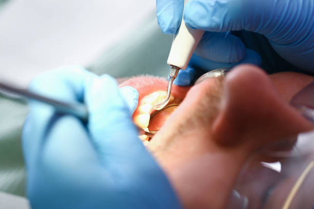 Best Emergency Dentist for Lost Fillings or Crowns in South Oroville, CA