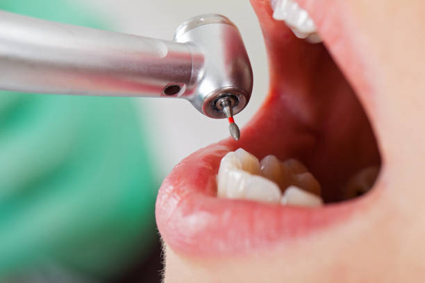 Best Emergency Dentist for Knocked-Out Tooth in South Oroville, CA